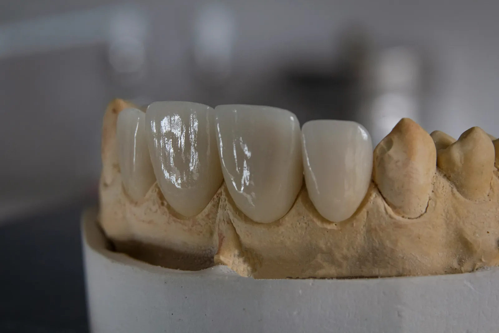 Carillas dentales: qué son, cuándo se indican y cuánto duran