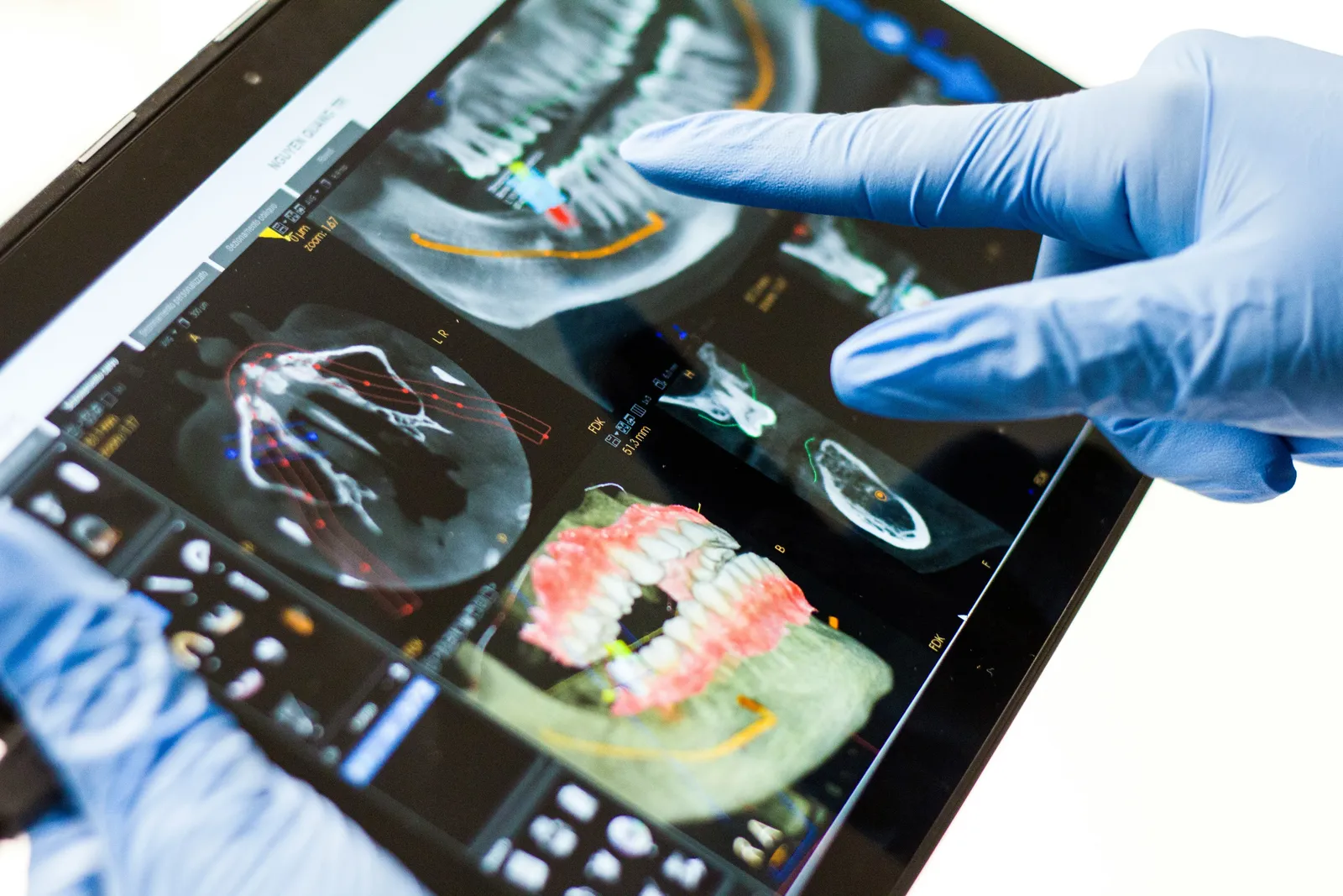 Radiografías dentales: ¿son seguras y cada cuánto se necesitan?