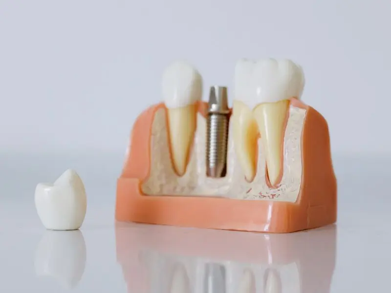 Detalle de Rehabilitación Oral en Planident